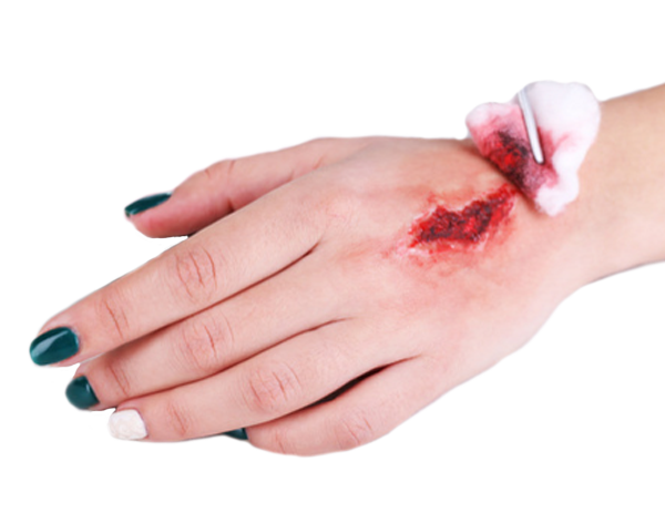 picture of an acute wound that can be healed by using a wound vac