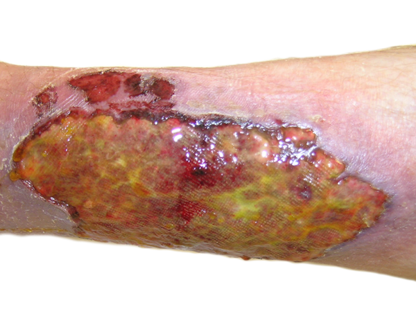 picture of a chronic wound on a transparent background for wound vac rentals 