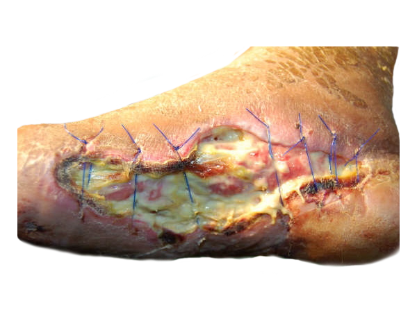 picture of a dehisced wound on a foot that you can use a wound vac on 