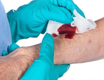 picture of an acute wound that is being cared for by a healthcare professional