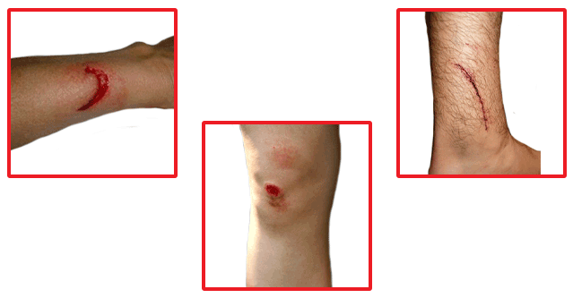 acute wound header with 3 different examples of what an acute wound looks like