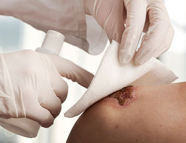 picture of a chronic wound being bandaged by a physician 