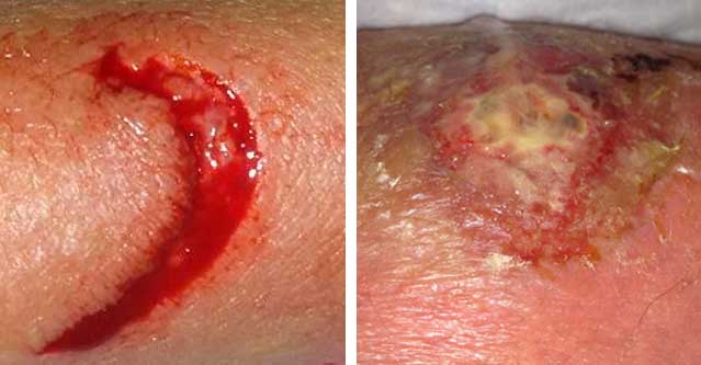 picture of a clean wound on the left that is not infected and an infected wound on the right for different types of wounds