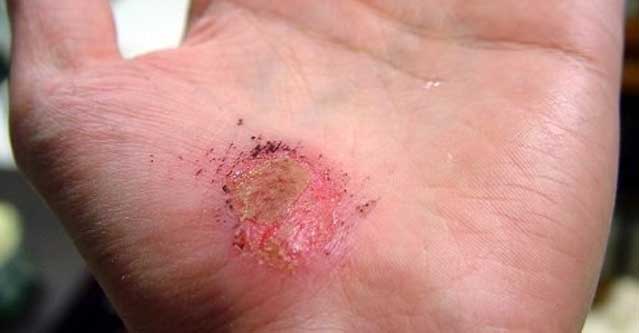 picture of an abrasion on the palm of a guys hand as he is looking down to evaluate his wound for basic wound care steps
